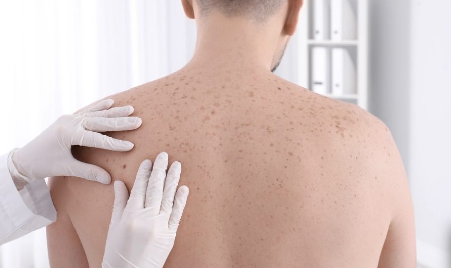 Why There is a Growing Need for Awareness Regarding Skin Cancer Screening in the UAE